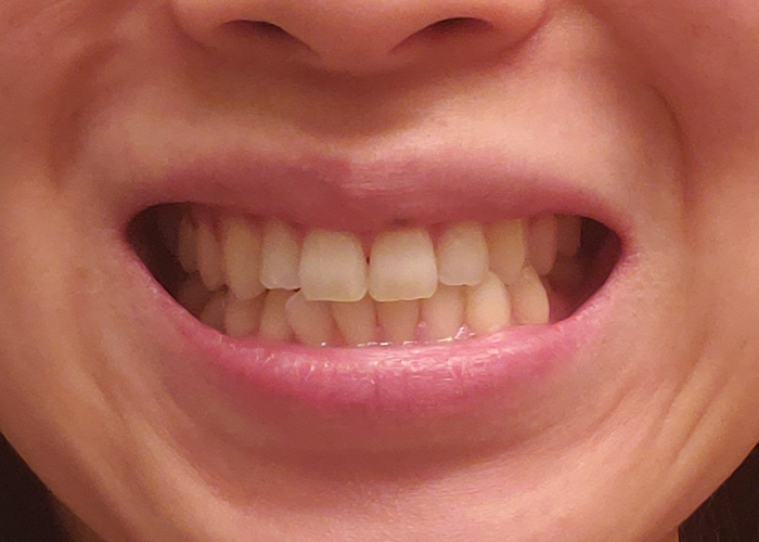 Front Teeth - before adult braces