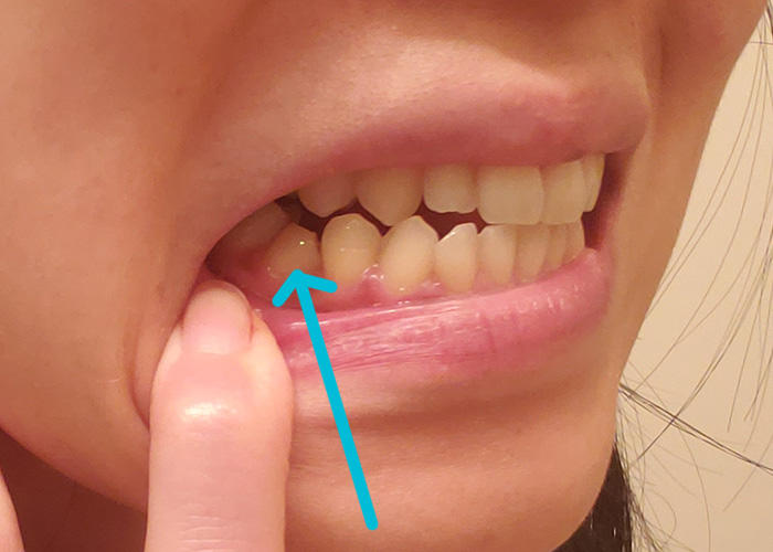 Teeth-Side view before braces